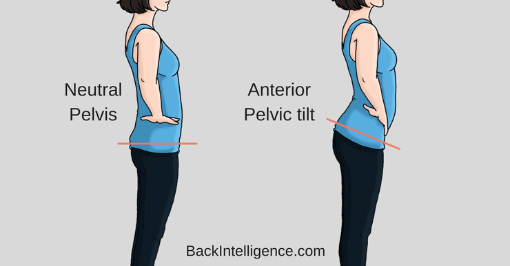 How To Fix Anterior Pelvic Tilt Posture - 10 Exercises | Back Intelligence