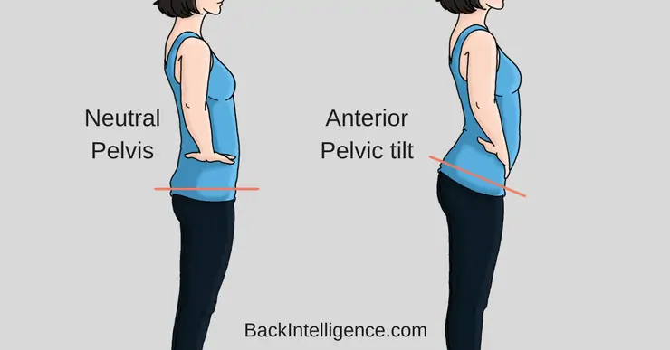 anterior pelvic tilt image