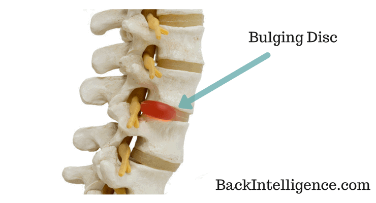 ipicture of bulging disc on spine