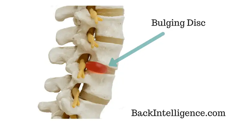 Bulging disc image