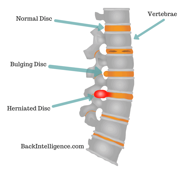 Spine model with discs