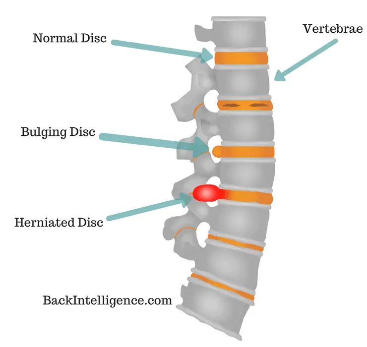 Spine model with discs