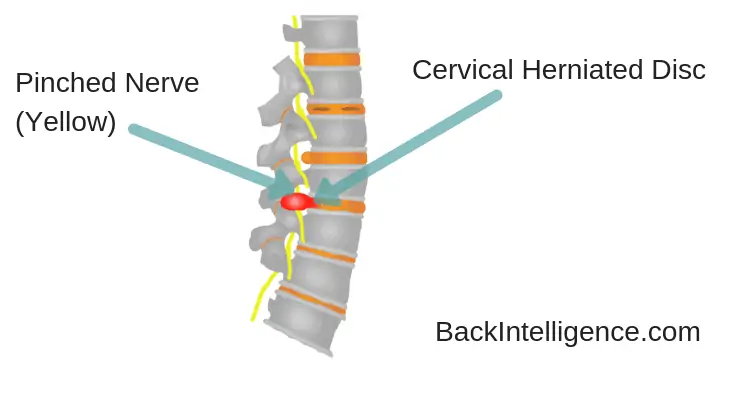 Cervical Herniated Disc Image