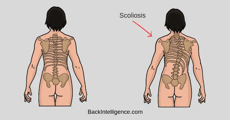 scoliosis spine curvature