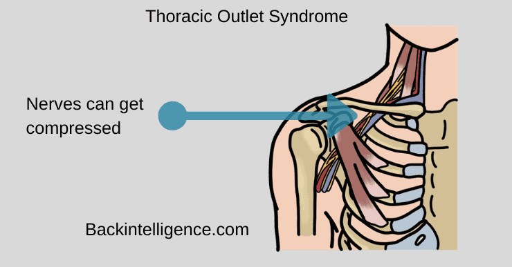 Thoracic outlet syndrome looks like