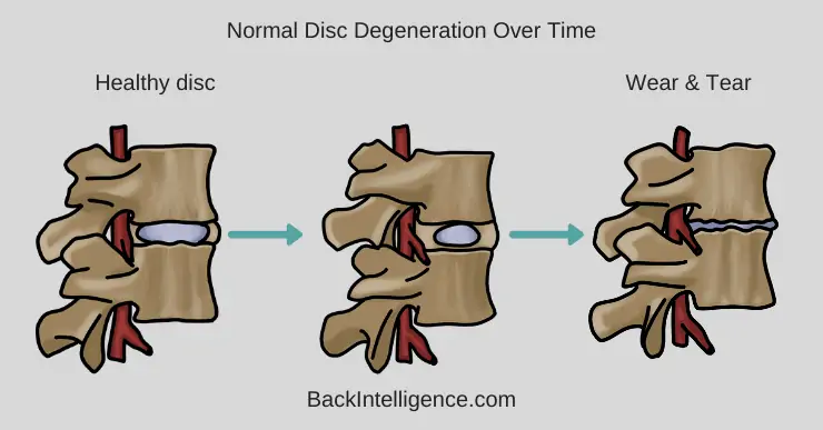 spondylolisthesis exercises