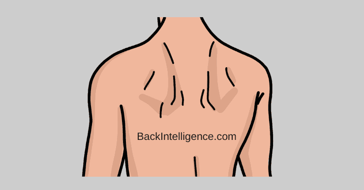 Winged Scapula image