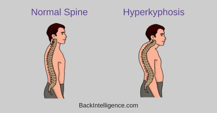 Dowager's Hump: What Is It, Symptoms, Diagnosis, & Treatment